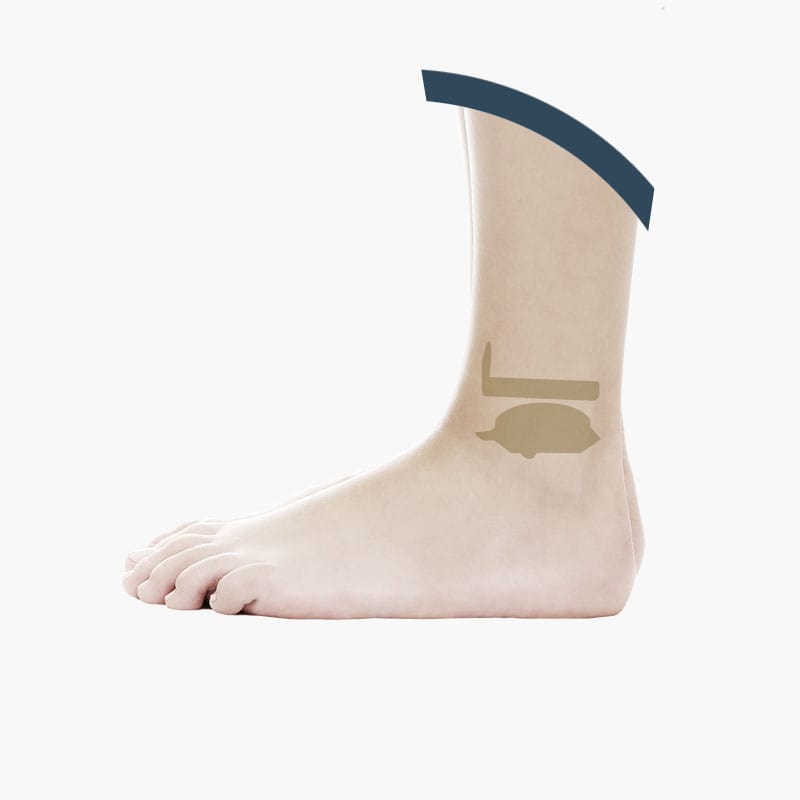 Ankle Proshtesis Mobile Bearing