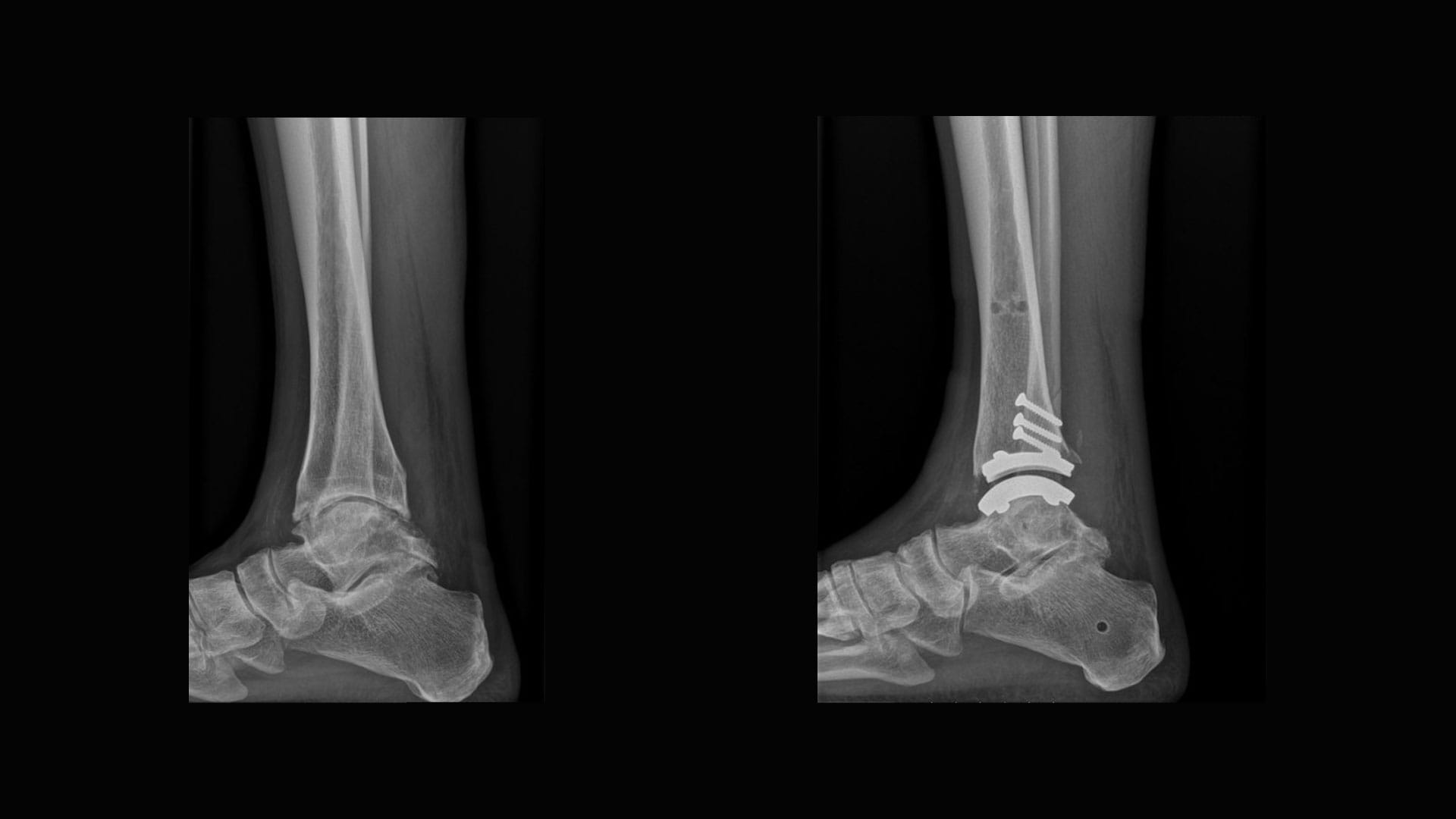 X-ray ankle prosthesis resurfacing